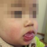 知ってほしい無痛無汗症