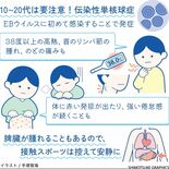 伝染性単核球症、10～20代は要注意　長引くだるさ、疲労感も【白鷗大・…