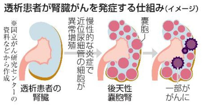 　透析患者が腎臓がんを発症する仕組み（イメージ）