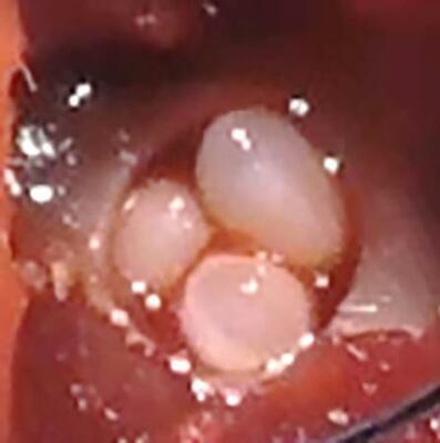 　マウスの下顎の欠けた部分に移植されたオルガノイド（京都大ｉＰＳ細胞研究所提供）