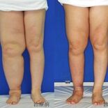 「リンパ浮腫」術後すぐにケア開始を　論文が医学雑誌で高評価　県立がんセ…