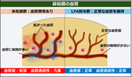アレルギー性鼻炎を血管から治す 新しい仕組みによる治療法の可能性
