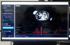 けがＣＴ画像、１０秒でＡＩ分析