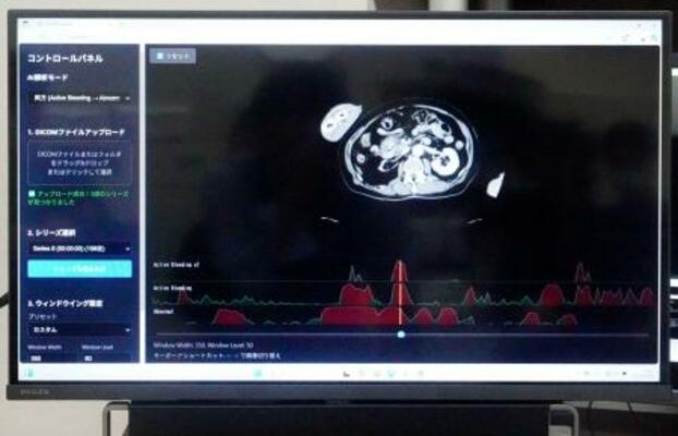 　ＡＩがＣＴ画像を解析するシステム「ＥＲＡＴＳ」の画面