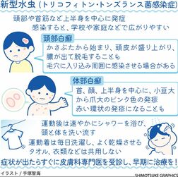 スポーツや学校で感染例もある「新型水虫」　練習後はすぐシャワー　症状出たら早期治療を【白鷗大・岡田教授が解説】