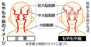１２時間 開頭手術経て復職