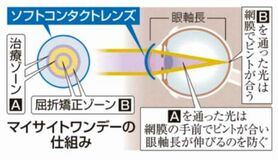 近視進行抑制の治療法が登場