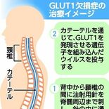 希少な指定難病の遺伝子治療へ　GLUT1欠損症　自治医大研究チーム、世…