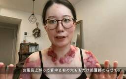 認知度低い過酷な難病