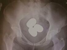 体内に隠す金の密輸が急増