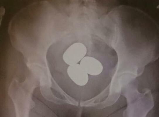 　東京税関成田税関支署が公表した、香港からの旅客が体内に粉状の金を隠し密輸しようとした摘発事例（同署提供）