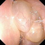 難治性の副鼻腔炎 増加