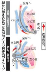 【からだ・こころナビ】東京女子医大、新術式で人工心臓植え込み