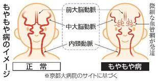 【医療新世紀】１２時間の開頭手術経て復職