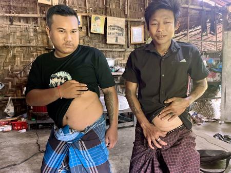 　ミャンマーのカンベ村で腎臓を摘出した手術痕を見せるチョウチョウさん（左）とカンコーさん＝２０２５年８月（共同）
