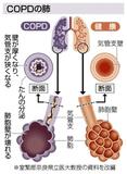 隠れ患者多いＣＯＰＤ