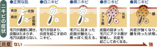 思春期に多いニキビ　自己流ではなく早期受診を