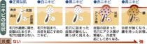 思春期に多いニキビ　自己流ではなく早期受診を
